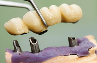 tipi di ponti dentali 