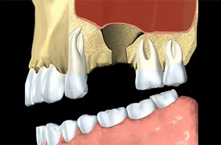 Impianto dentale con innesto osseo