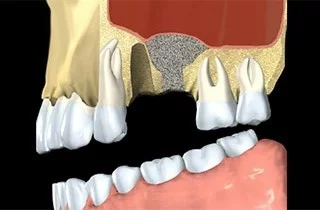 impianto dentale innesto osseo