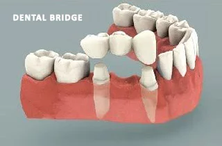 ponte dentale o impianto dentale