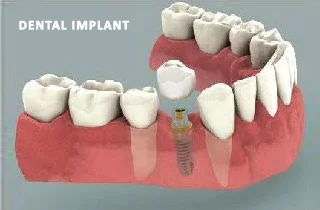 Ponte dentale o impianto