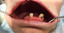 Denti mancanti 