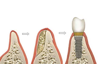 Rigenerazione ossea dentale costi
