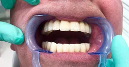 impianti dentali raccomandazioni