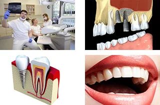 tipi di impianti dentali