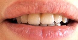 corona dentale prima