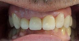corone dental dopo