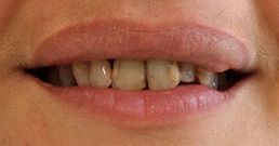 Corone dentali prima