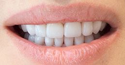 estetica dentale prima e dopo