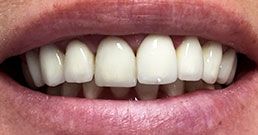 Estetica dentale: sorriso da Hollywood