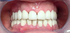scolorimento dei denti